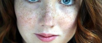 How to get rid of freckles