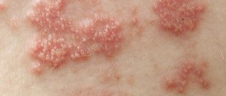 what does herpes look like on a child&#39;s body?