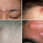 Cysts on the forehead and between the eyebrows
