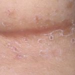 Cutaneous candidiasis: what is it and how is it transmitted?