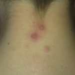 Hives on the neck causes
