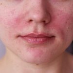 Causes of red cheeks in an adult