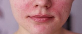 Causes of red cheeks in an adult