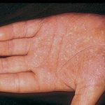 Palm of a person with skin affected by psoriasis