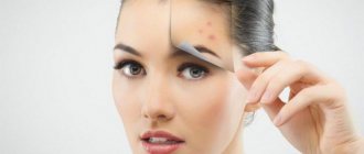 Treatment of acne on the face