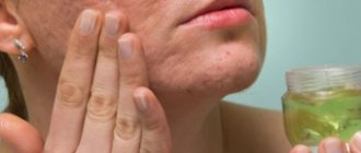 The best anti-acne creams