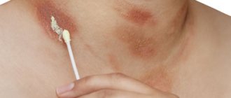 Medication and folk treatment of burn-like spots