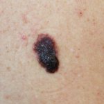 back skin melanoma