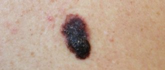 back skin melanoma