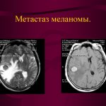 Melanoma metastases