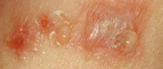Weeping dermatitis: features of the disease and treatment options