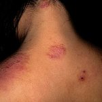 Coin-shaped eczema: definition, symptoms, treatment