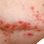 What dry pimples on the skin can tell you