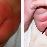 Diaper rash on baby&#39;s bottom