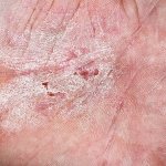 Main symptoms and treatment methods for neurodermatitis on the hands
