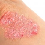 What causes psoriasis - MedExplorer - information site about ...