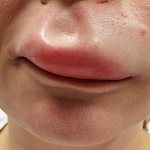 swelling of the upper lip in an adult
