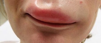 swelling of the upper lip in an adult