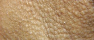 перламутровые гранулы, мелкие узелки на коже