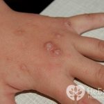 Flat warts are called juvenile warts because they most often affect children and young people