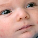 Почему на лице малыша возникают белоснежные пятна