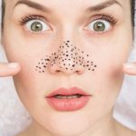 Why do pimples and blackheads appear on the skin?