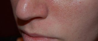 Why do pores expand?