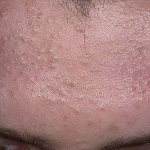 Subcutaneous pimples on the forehead causes