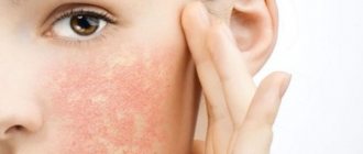 Redness and rashes on the skin