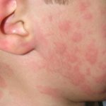 Causes of rashes on the body
