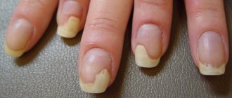 Causes of nail disease