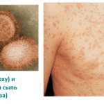 Signs of rubella in adults