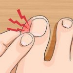 Problems with toenails