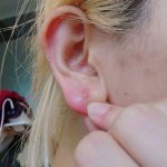 Pimple on the earlobe: reasons, what to do with internal, subcutaneous photo