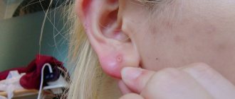 Прыщ на мочке уха: причины, что делать с внутренним, подкожным фото
