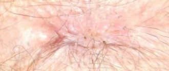 Pimple near the anus: causes and treatment at home