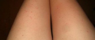 Acne on thighs in women