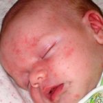 Pimples on a child&#39;s nose - how to treat them
