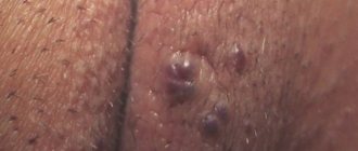 pimples on the labia