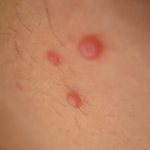 Pimples under the arms hurt: what to do? Causes and treatment at home 