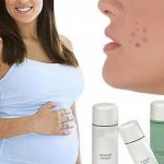 Acne in pregnant women