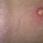 Pimples in the intimate area may mean a sexually transmitted infection