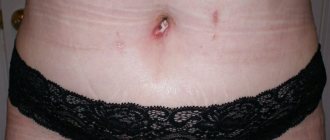 Acne around, near and below the navel causes and treatment photo