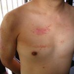 Psoriasis on the penis: what are the distinctive signs of the disease...