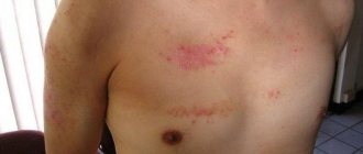 Psoriasis on the penis: what are the distinctive signs of the disease...