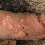 blisters on the genitals and groin due to herpes