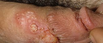blisters on the genitals and groin due to herpes