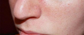 enlarged pores on the face