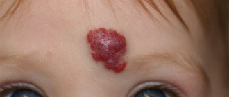 Do moles grow with the child?