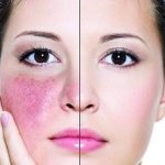 Rosacea in a woman